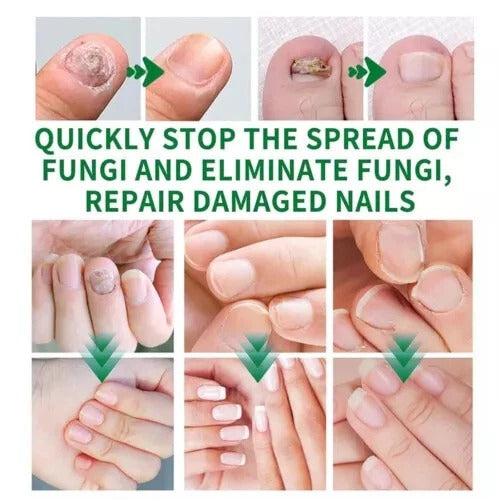 Nail Fungus Treatment Gel – Restore Healthy & Clear Nails Fast