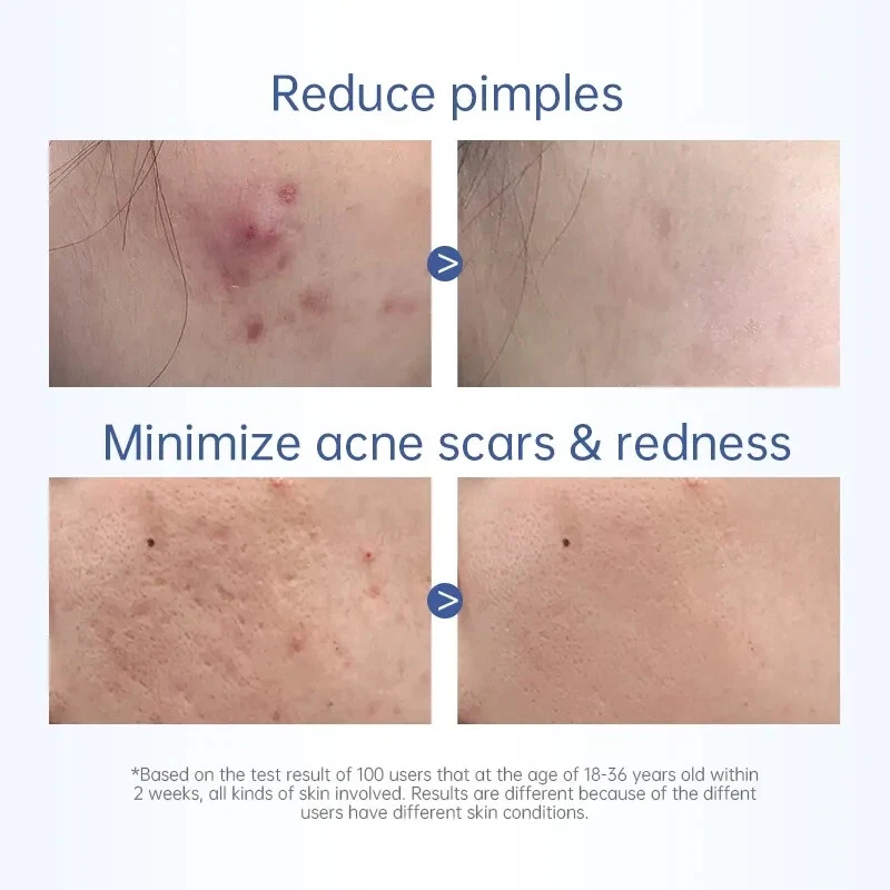 Salicylic Acid Spot Drying Lotion – Targeted Acne Care