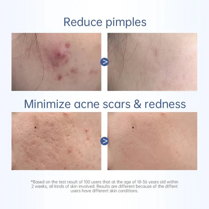 Salicylic Acid Spot Drying Lotion – Targeted Acne Care