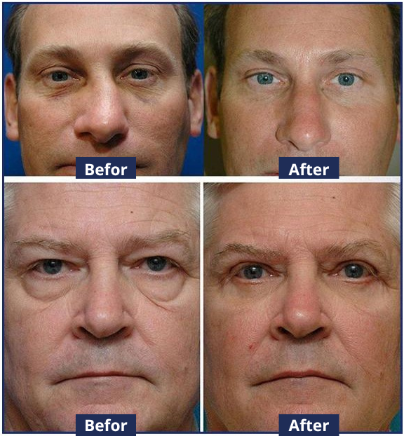 OPENEYES Lifting Eye Gel
