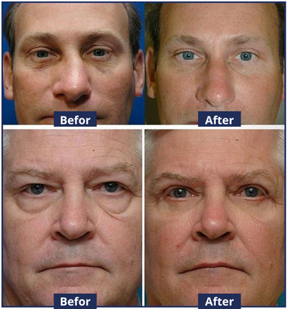 OPENEYES Lifting Eye Gel