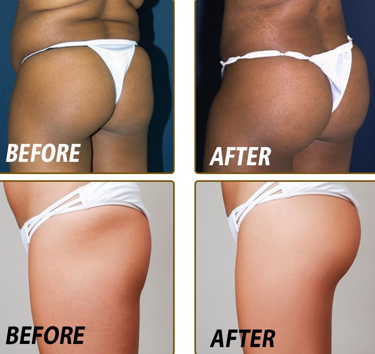 BunLift Buttocks Essential Oil