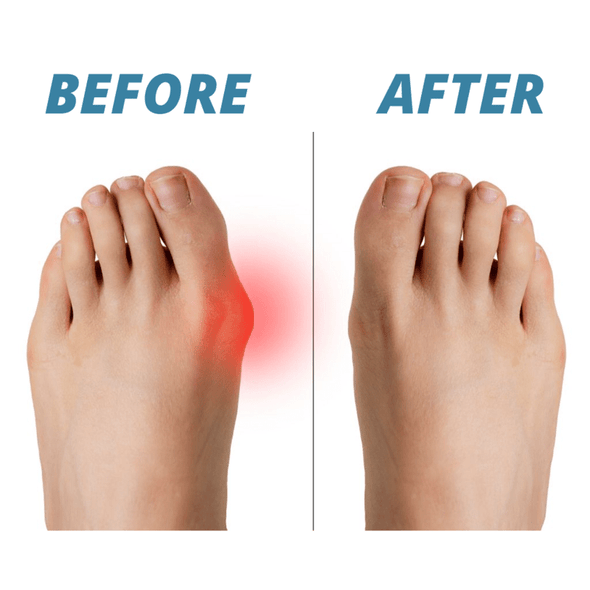 Premium Bunion Corrector (set of 2 pieces)